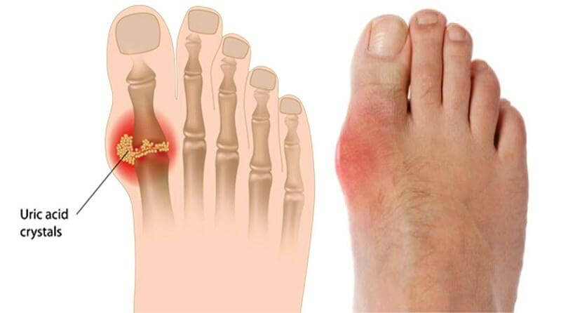 nấm linh chi với bệnh gout