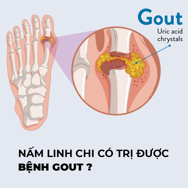 nấm linh chi với bệnh gout